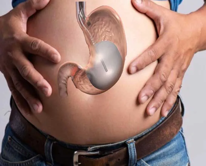 معجزه ای برای رسیدن به اندام ایده آل با بوتاکس معده