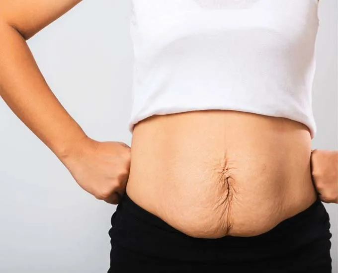 افتادگی پوست بعد از لاغری چرا و چگونه رخ می‌دهد؟