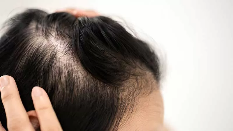 بهترین روش درمان ریزش مو بانوان در شیراز