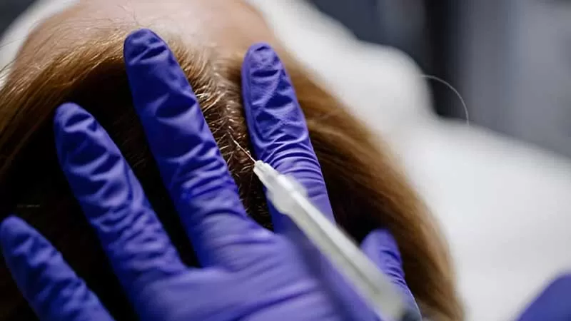 بهترین دکتر درمان ریزش مو در شیراز