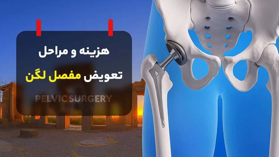 هزینه و مراحل تعویض مفصل لگن در شیراز (معرفی پزشکان)