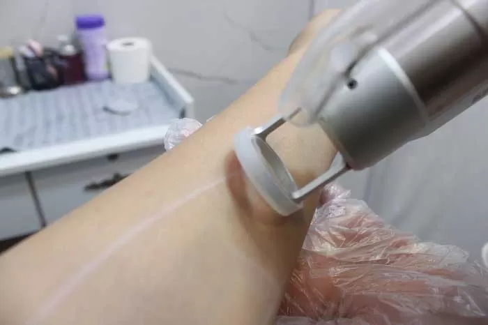 بهترین مرکز لیزر بیکینی در اصفهان با دستگاه الکساندرایت نابلکس 