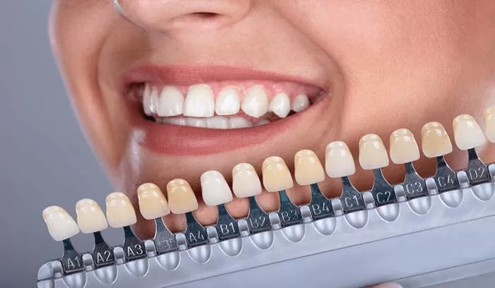 انتخاب لمینت دندان