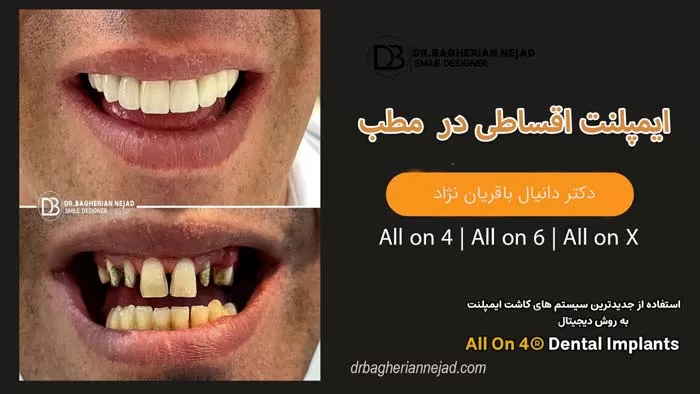 پیش پرداخت 30 در صد ایمپلنت دندان