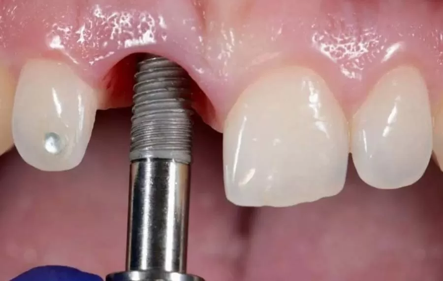 معرفی کلینیک دندانپزشکی برای ایمپلنت اقساطی در اصفهان