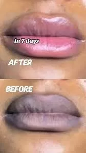 از بین بردن تیرگی لب