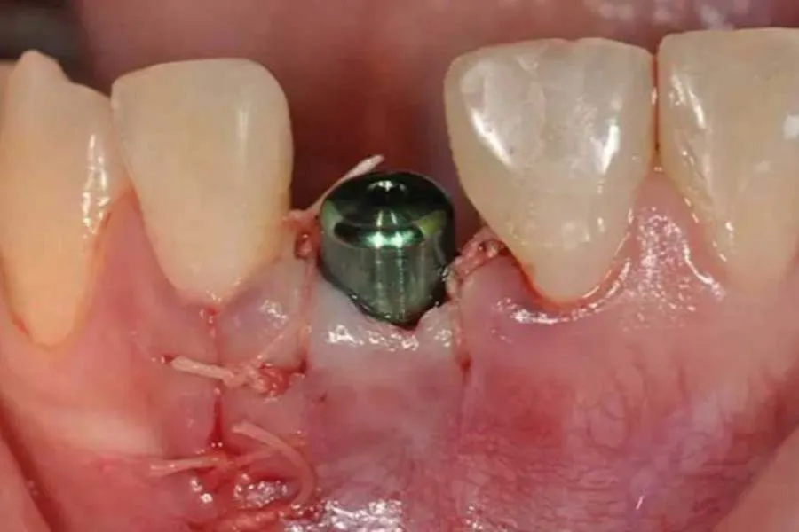 اگر بخیه ایمپلنت باز شود چه کنیم؟