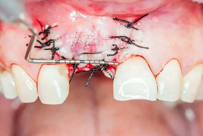 علت باز شدن بخیه ایمپلنت