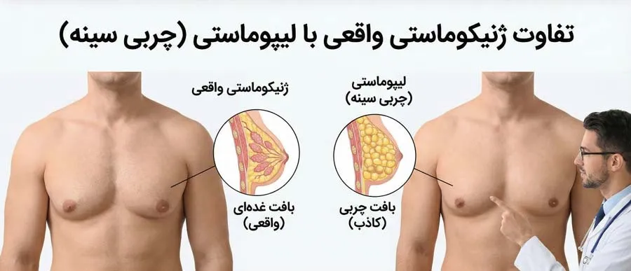 تفاوت ژنیکوماستی واقعی با لیپوماستی (چربی سینه)
