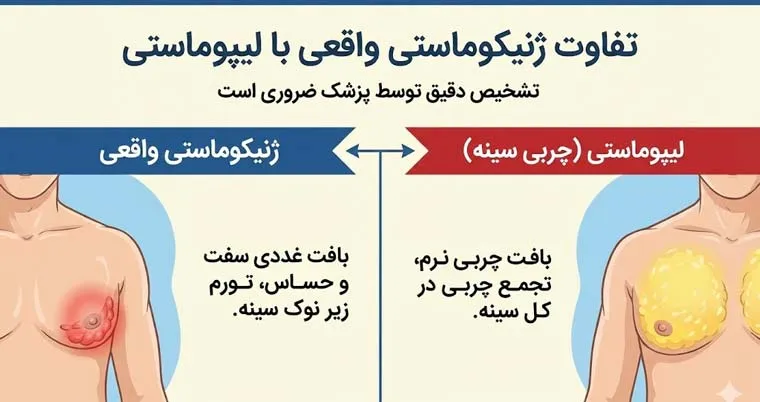 تفاوت‌های بین ژنیکوماستی و لیپوماستی