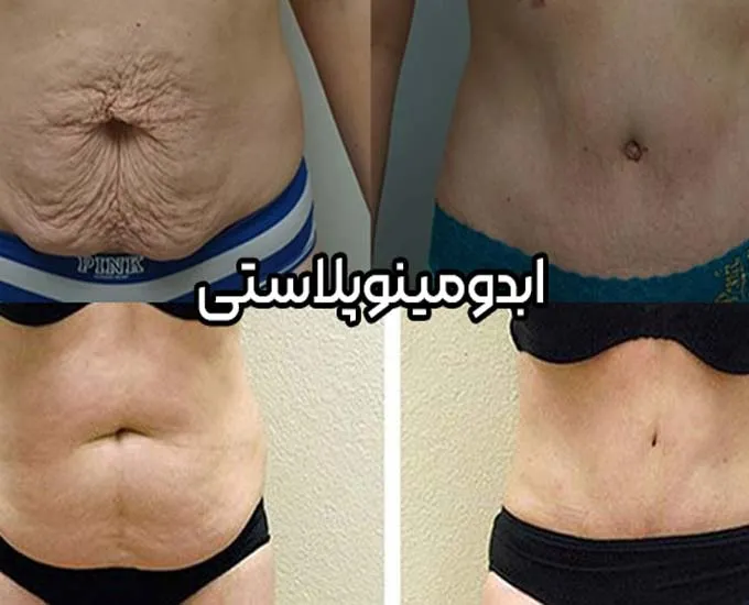 راهنمای جامع عمل ابدومینوپلاستی و لیپوماتیک در کرج