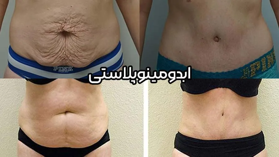 راهنمای جامع عمل ابدومینوپلاستی و لیپوماتیک در کرج