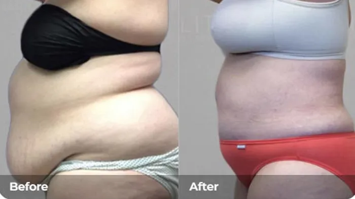 مزایا و معایب ابدومینوپلاستی و لیپوماتیک