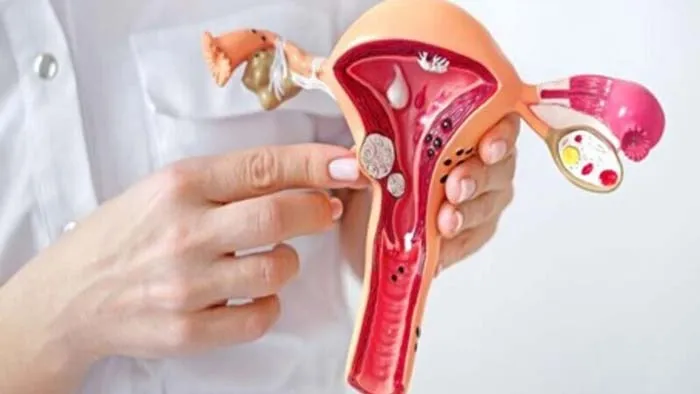 درمان فیبروم رحم در تهران