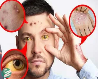 علائم کبد چرب در صورت؛ 8 نشانه هشداردهنده که نباید نادیده بگیرید