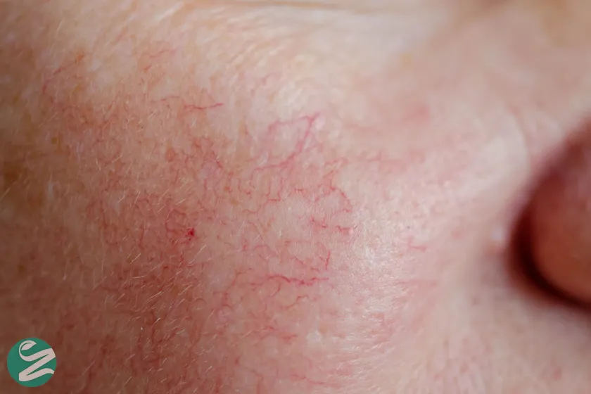 رگهای عنکبوتی زیر پوست