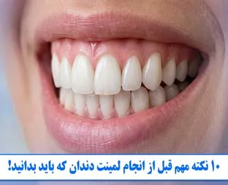 10 نکته مهم قبل از انجام لمینت دندان که باید بدانید!