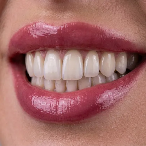قبل از لمینت دندان به این نکات توجه کنید
