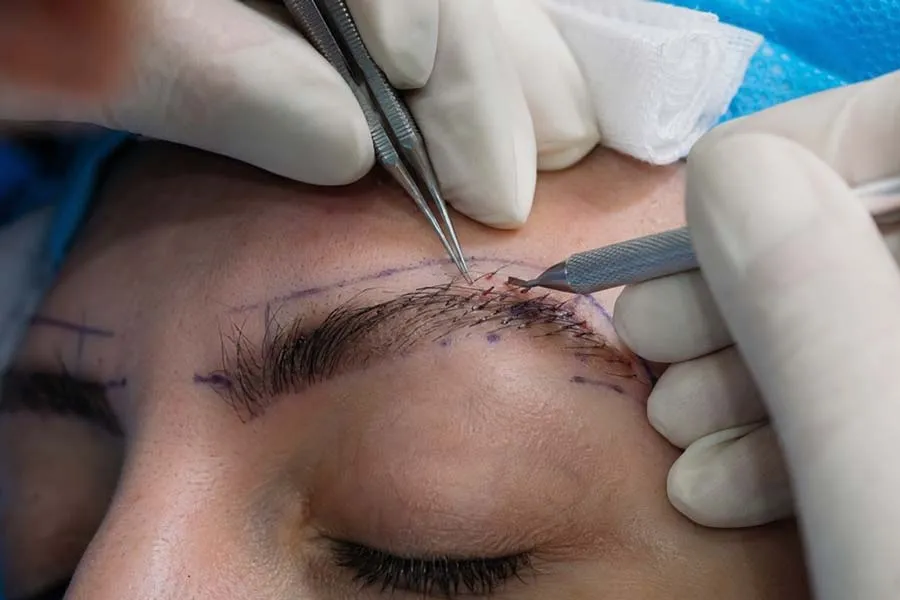 کاشت ابرو با روش NTF؛ بررسی تکنیکی کاهش آسیب بافتی و طراحی طبیعی ابرو