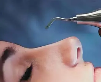 عمل بینی به روش پیزوسرجری؛ کاندیدای مناسب چه کسانی هستند؟