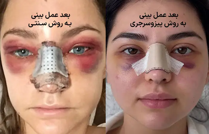 تفاوت عمل بینی به روش پیزوسرجری و عمل بینی رایج