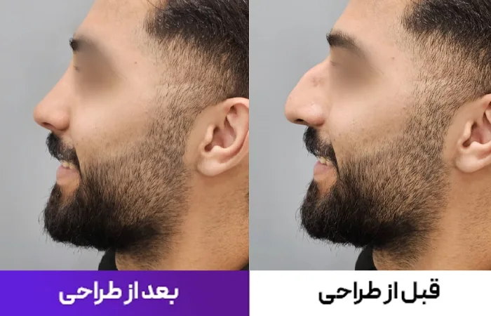 طراحی بینی رینوبات قبل از عمل بینی به روش پیزو