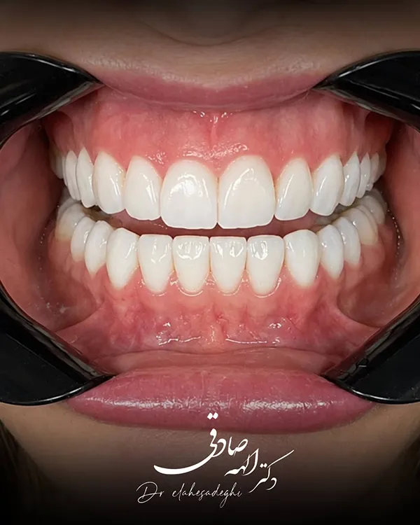 لمینت دندان