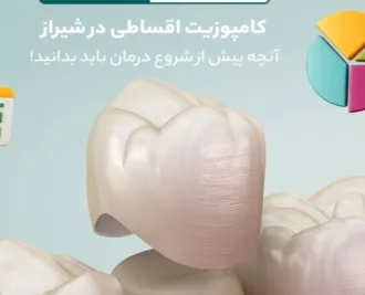 کامپوزیت اقساطی در شیراز؛ آنچه پیش از شروع درمان باید بدانید!