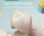 کامپوزیت اقساطی در شیراز؛ آنچه پیش از شروع درمان باید بدانید!