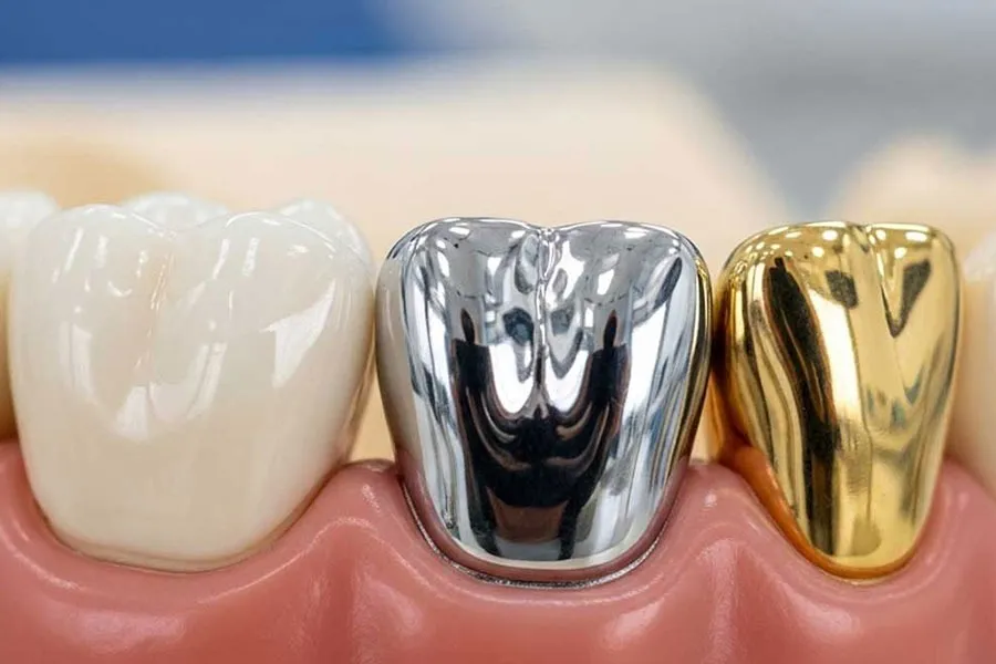روکش دندان هم تاریخ انقضا دارد؛ نشانه هایی که نباید نادیده بگیرید